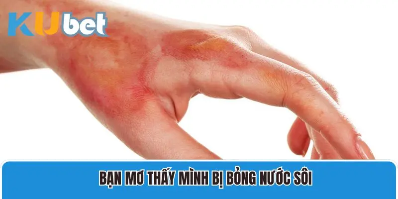 Mơ thấy mình bị bỏng nước sôi và ý nghĩa liên quan